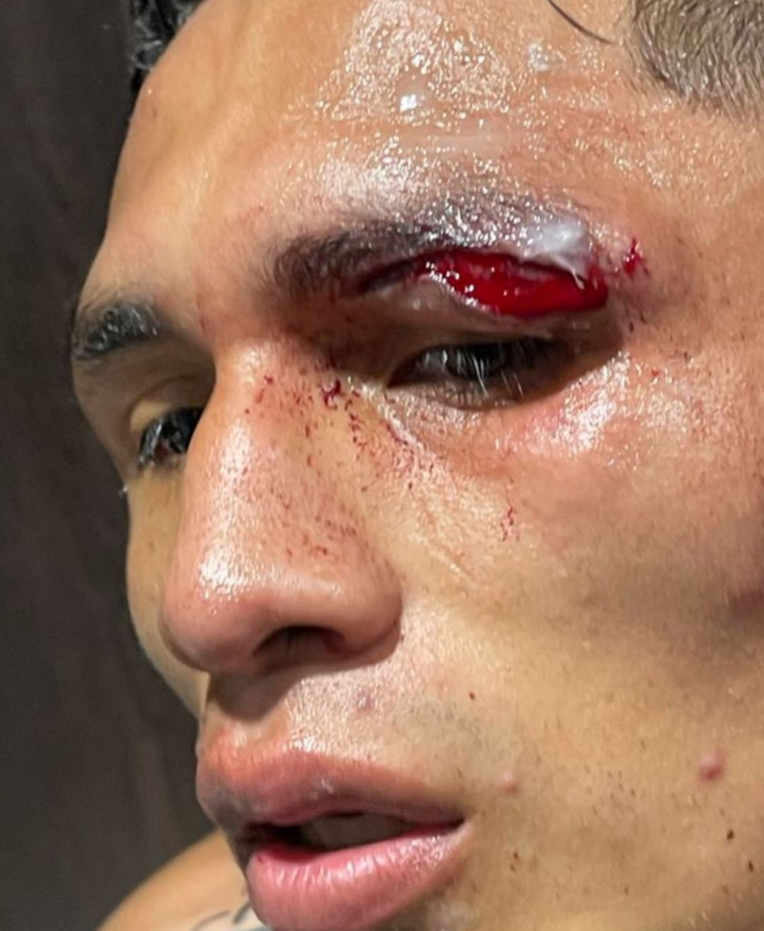 Eddie Hearn shared a disturbing snap of Mauricio Lara's horror eye-cut that led to his rematch against Josh Warrington being cancelled