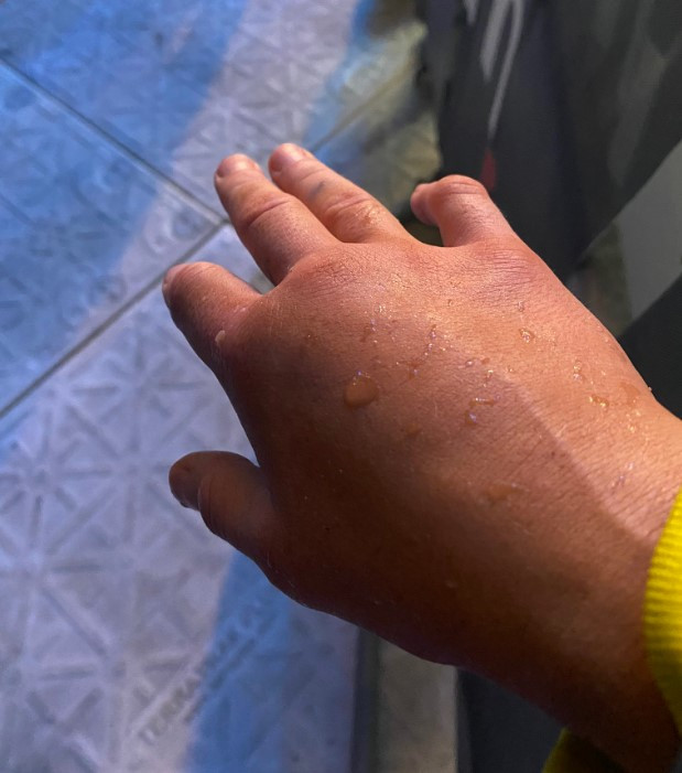 After a hard-fought victory over Mailys Gangloff, Ebanie Bridges shared a nasty picture of a suspected broken hand