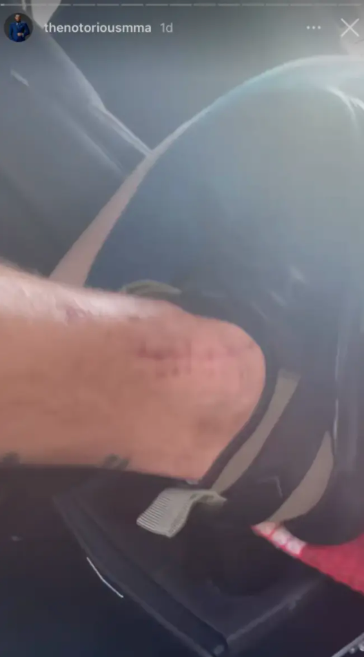 After UFC star Conor McGregor says he feels like he can kick right now, Conor McGregor shows off his huge scars from a broken leg.