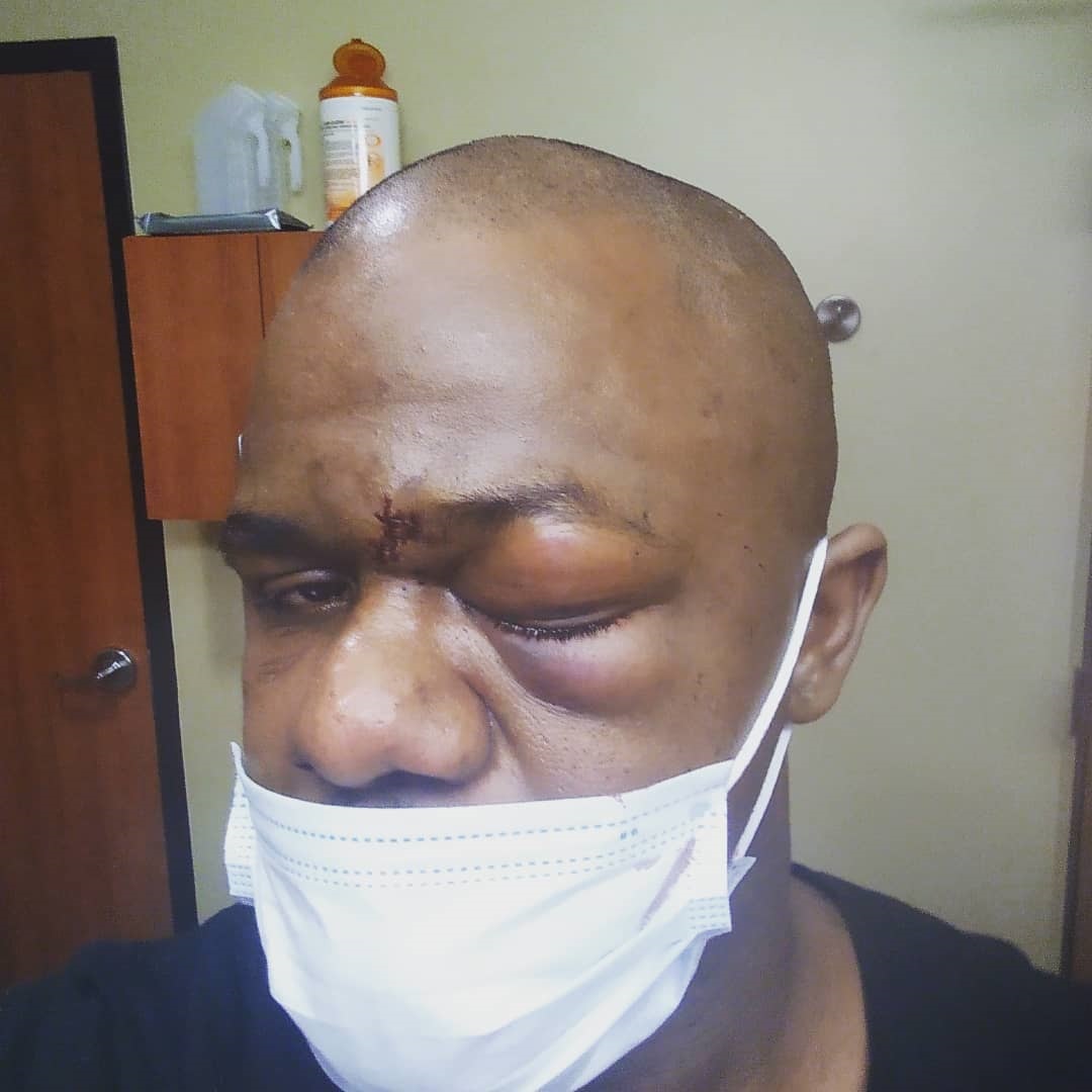 Melvin Guillard, ex-UFC star, shows horror eye injury that requires surgery following brutal Bare Knuckle fight