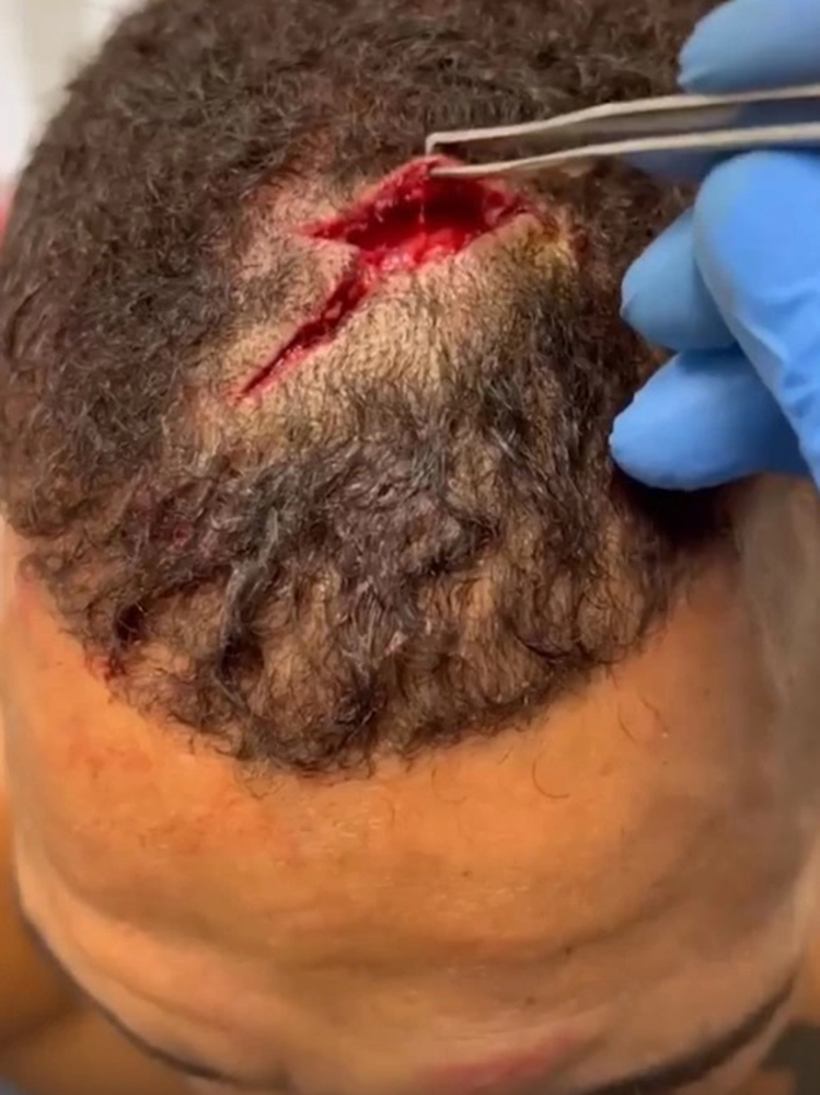 UFC fighter Danny Roberts won CUT OPEN despite Ramazan Emeev's brutal elbow, but still wins