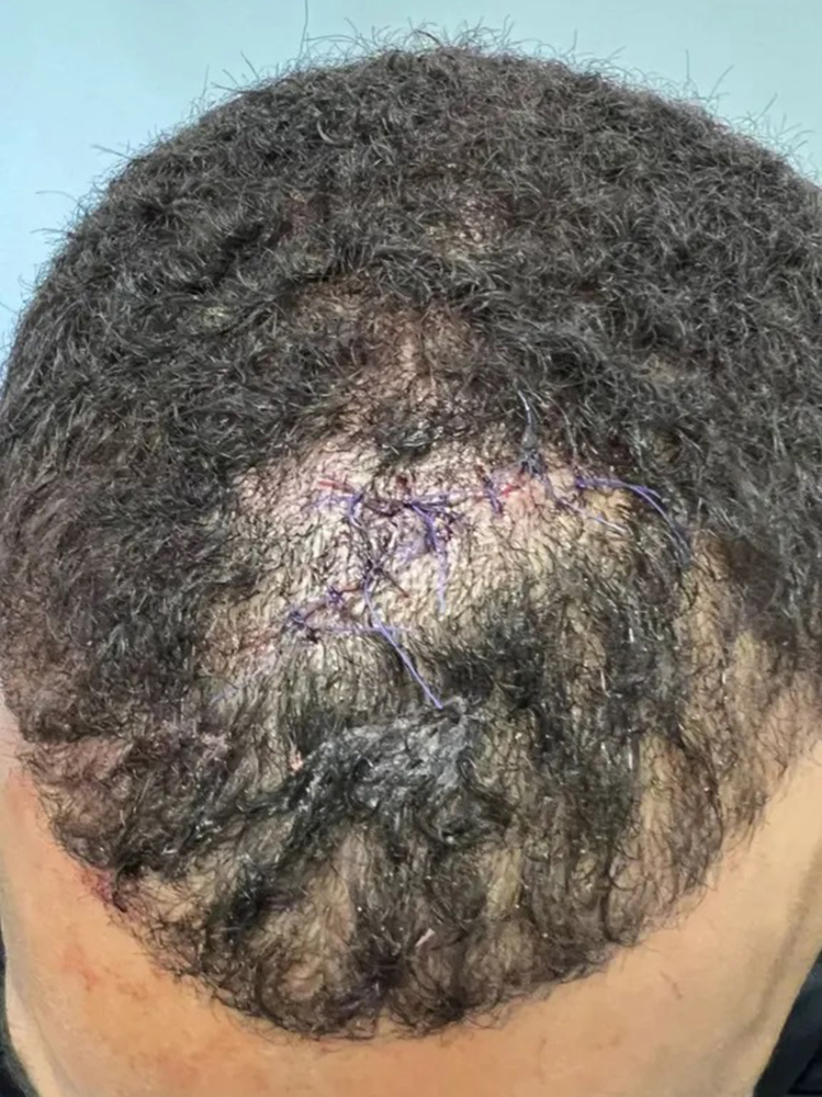 UFC fighter Danny Roberts won CUT OPEN despite Ramazan Emeev's brutal elbow, but still wins