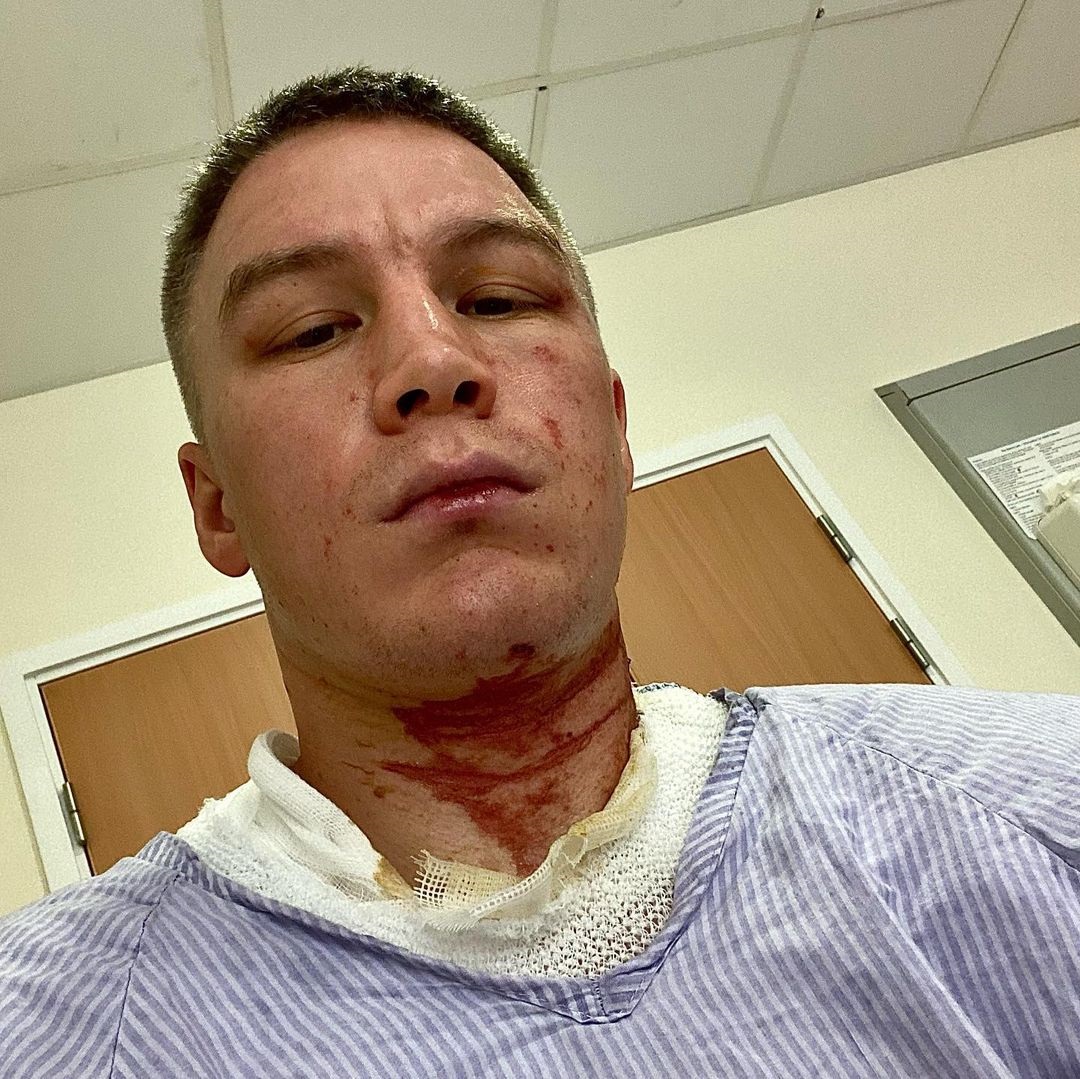 Boxer Viktor Kotochigov displays horror burns after an 'ACID attack' by a gang of men broke into a UK hotel room