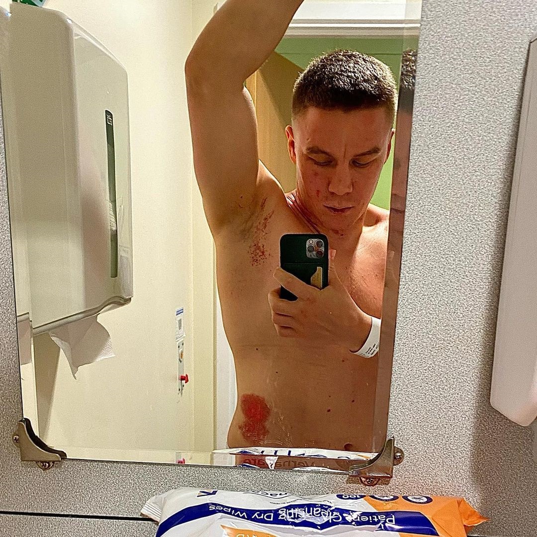 Boxer Viktor Kotochigov displays horror burns after an 'ACID attack' by a gang of men broke into a UK hotel room