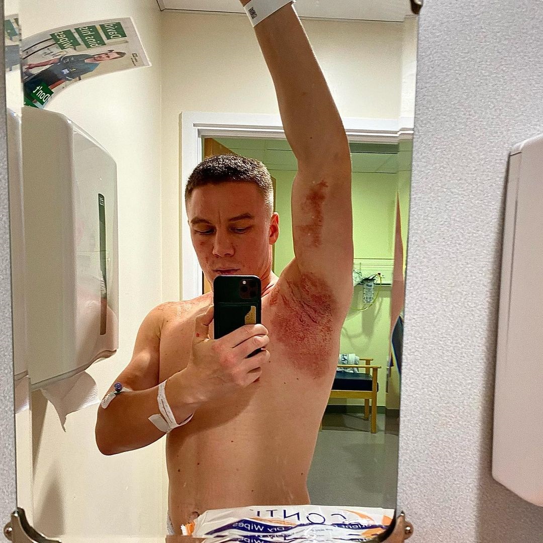 Boxer Viktor Kotochigov displays horror burns after an 'ACID attack' by a gang of men broke into a UK hotel room