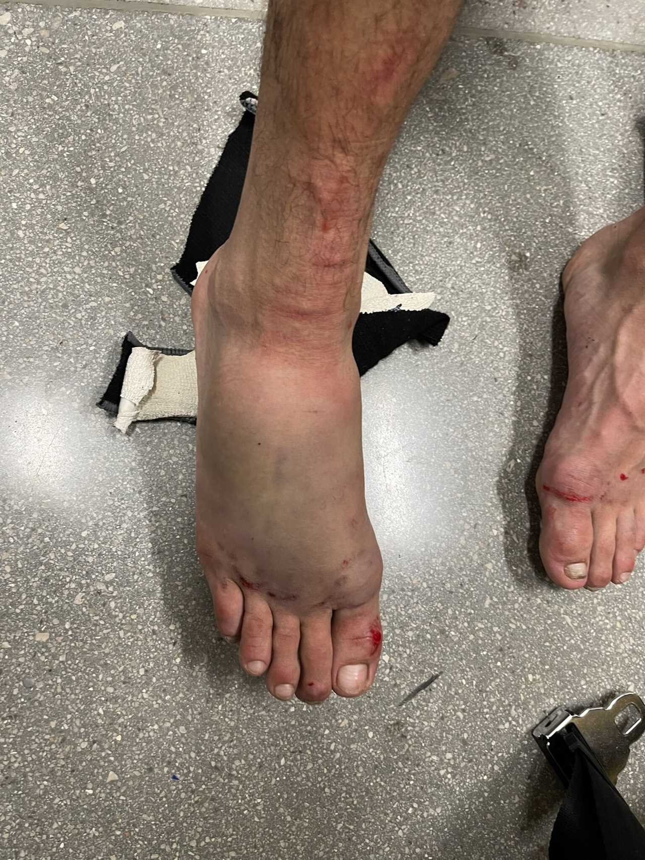 UFC star Yair Rodrigues reveals grotesque swelling in his foot after a brutal fight against Max Holloway