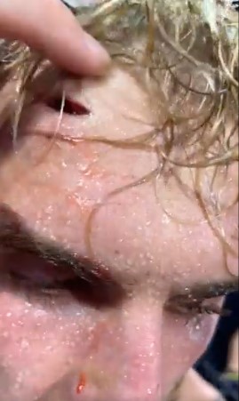 Logan Paul shows his brother Jake's horrific gash in the rematch victory against former UFC champ Tyron Woodley