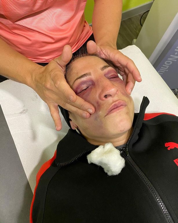 Gutierrez, a female fighter, shares a photo of horrendous facial injuries sustained in Serrano beatings and says she may never again box.