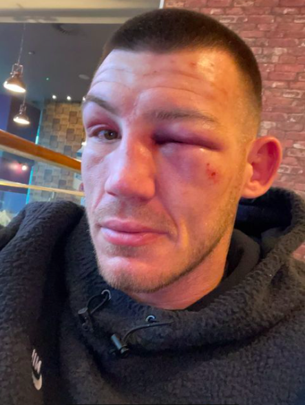 After Chris Eubank Jr beating, Liam Williams displays a severe eye injury and battered appearance.