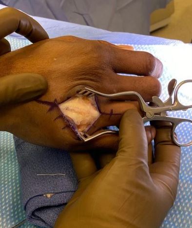 Kamaru Usman's fist has opened during hand ligament surgery. UFC chief Dana White shares vomiting-inducing photos