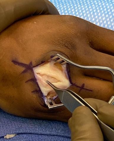Kamaru Usman's fist has opened during hand ligament surgery. UFC chief Dana White shares vomiting-inducing photos
