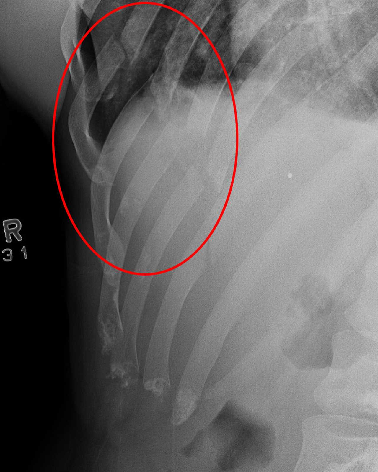 Bellator MMA fighter rushed to hospital after suffering FIVE broken ribs and punctured lung after brutal spinning kick