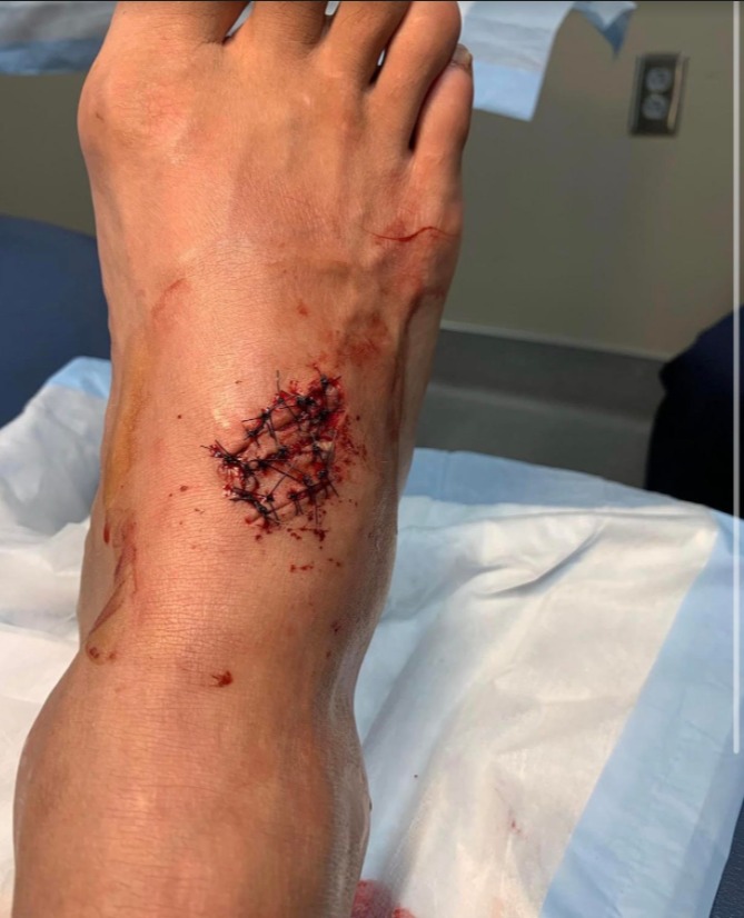 UFC star Eryk Anderson shares gruesome gash after horror CHAINSAW incident to make fans sick