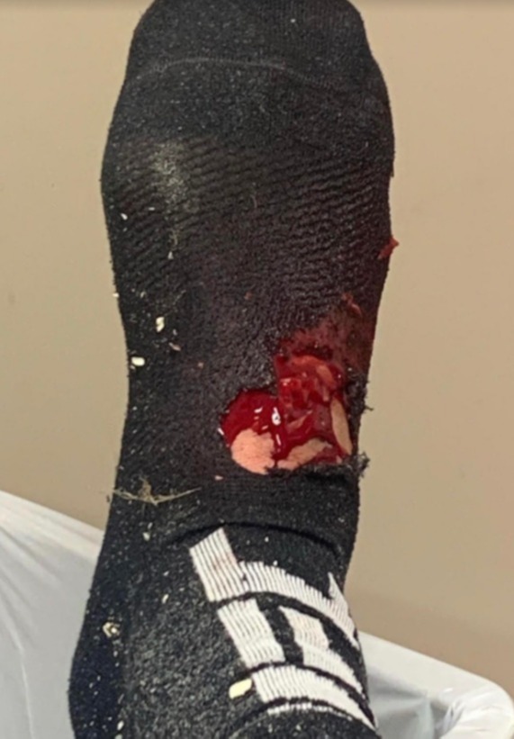 UFC star Eryk Anderson shares gruesome gash after horror CHAINSAW incident to make fans sick