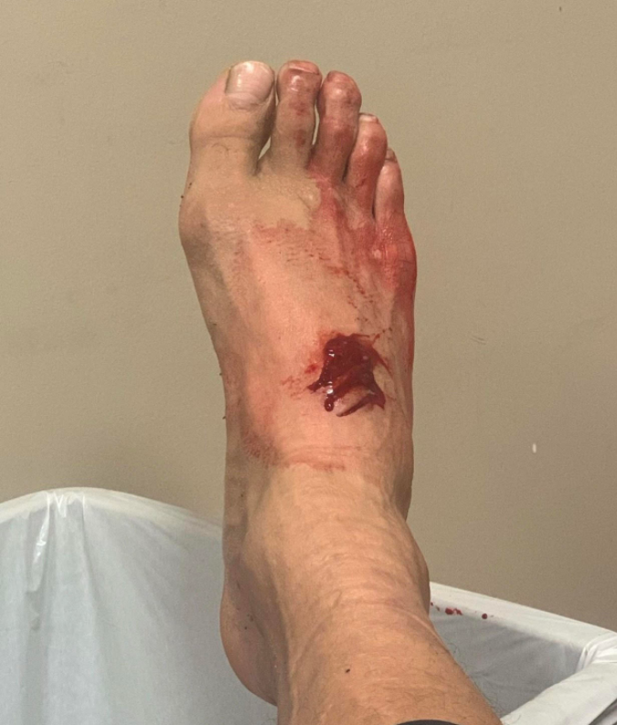 UFC star Eryk Anderson shares gruesome gash after horror CHAINSAW incident to make fans sick