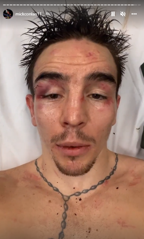 Michael Conlan's horrific facial injuries after falling through the ropes during horror KO vs Leigh Wood