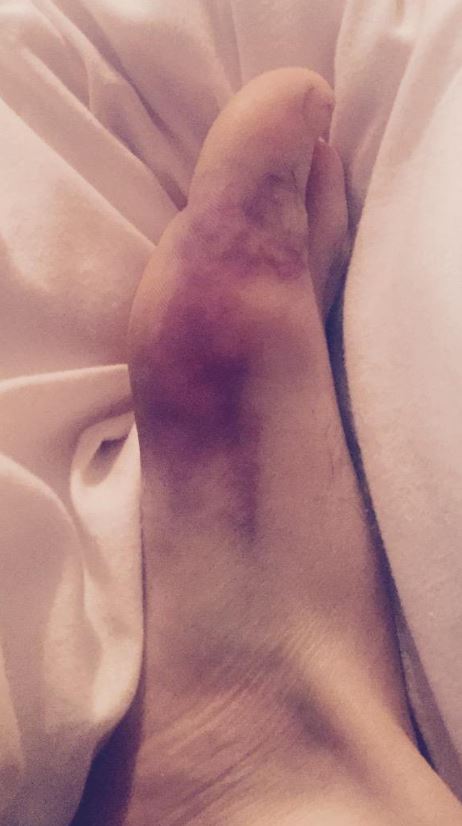 Boxers have canceled fights at the most bizarre and unusual times, including Joseph Parker's Spider Bite.