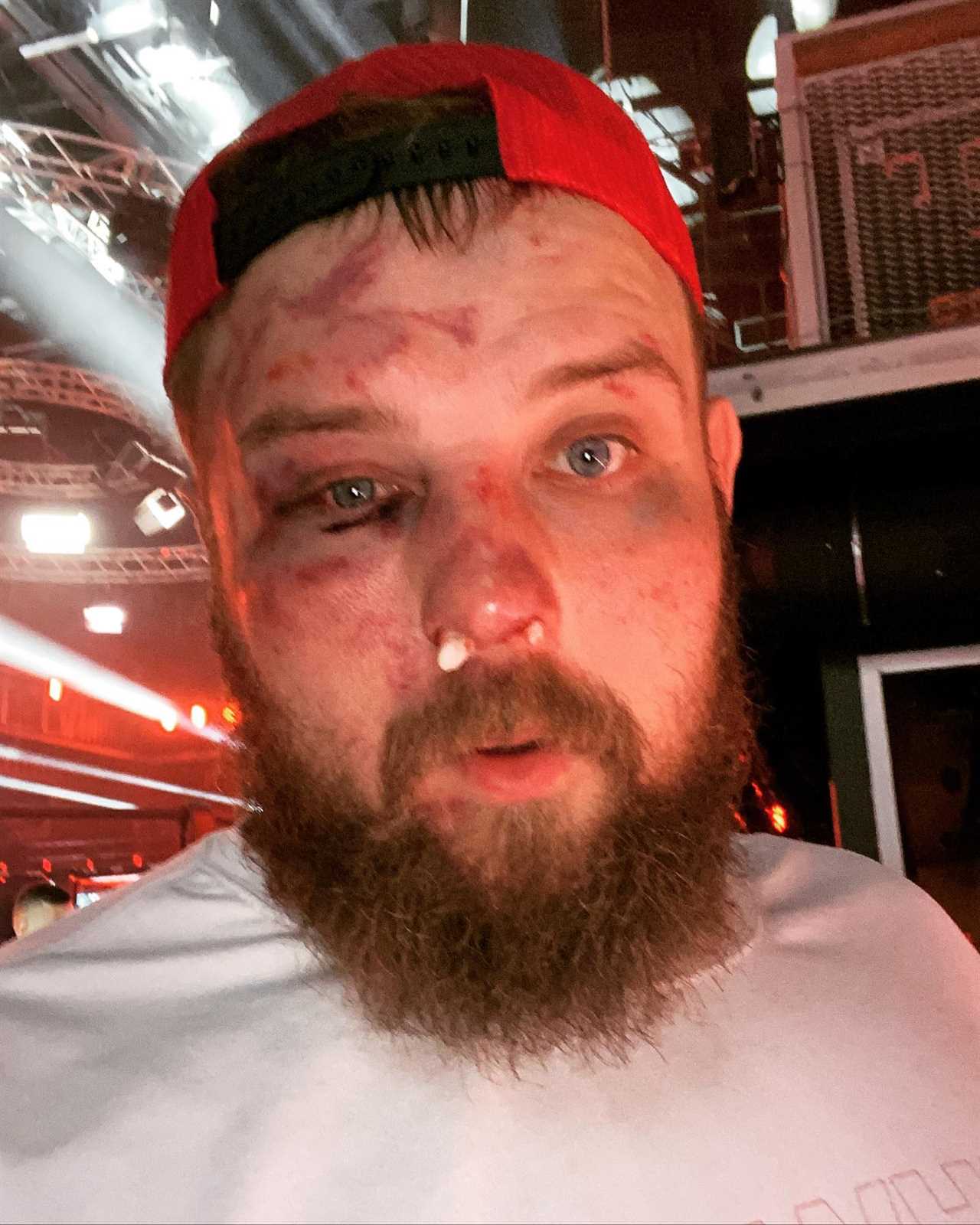 Vasily Kamotsky, the face-slapping king, shows horror injuries after being beaten in a bare-knuckle fight