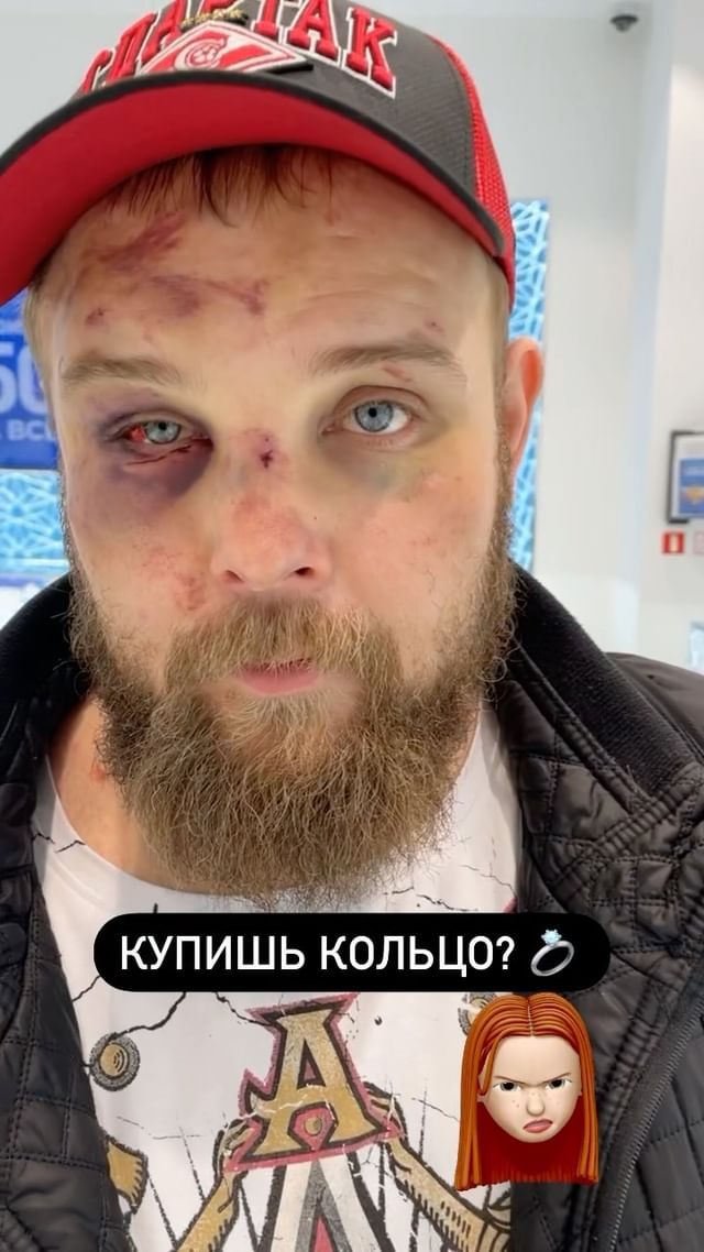 Vasily Kamotsky, the face-slapping king, shows horror injuries after being beaten in a bare-knuckle fight