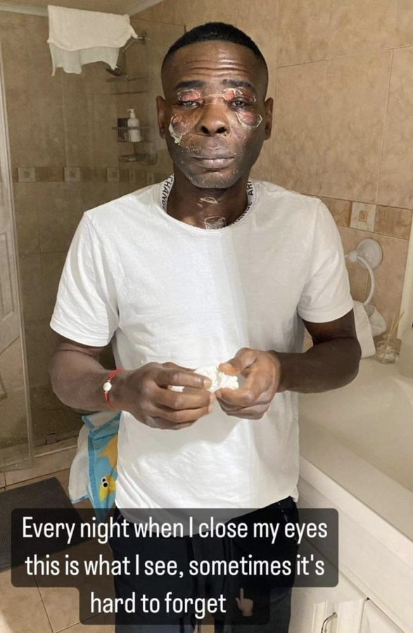 Guillermo Rigondeaux is now unrecognizable after suffering horrific facial burns from a pressure cooker explosion.