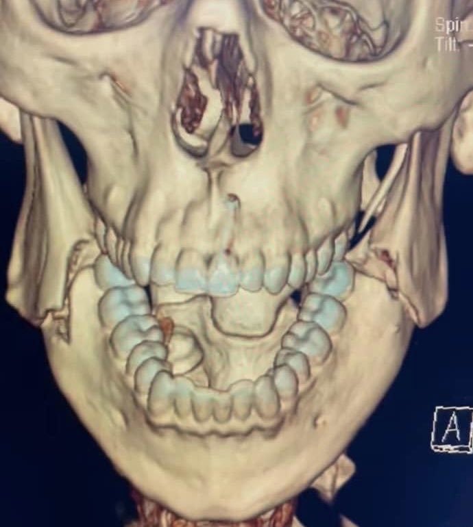 Opetaia, Boxer, shares frightening X-rays of horrendous broken jaw following second round fracture. However, he won the fight.