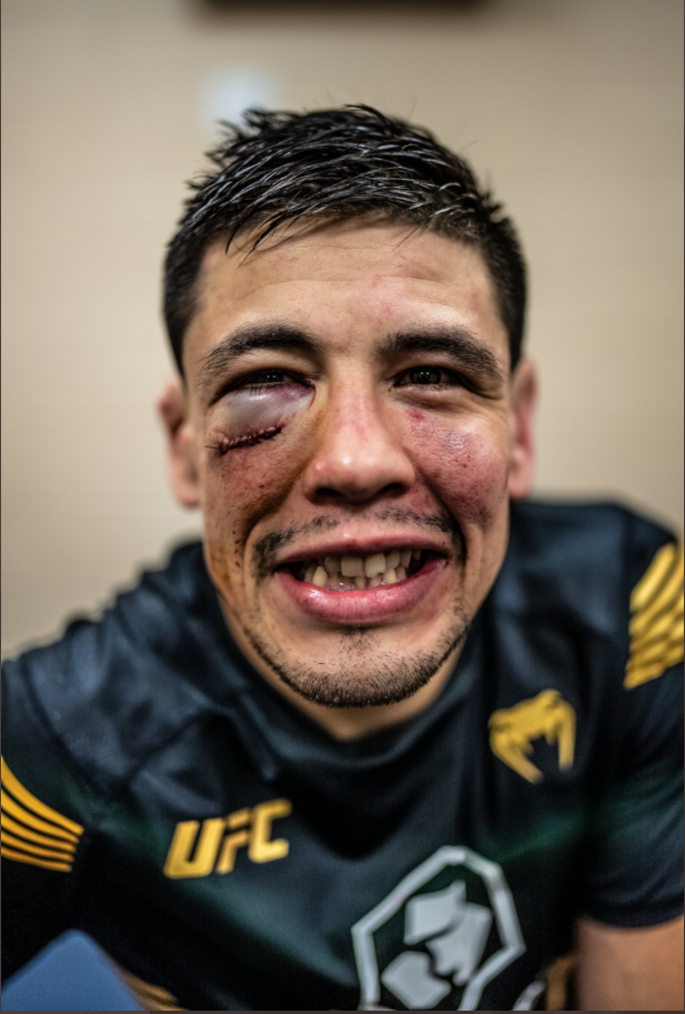 UFC star Brandon Moreno is unrecognizable after suffering horrific facial injuries following his title fight win Kai Kara France