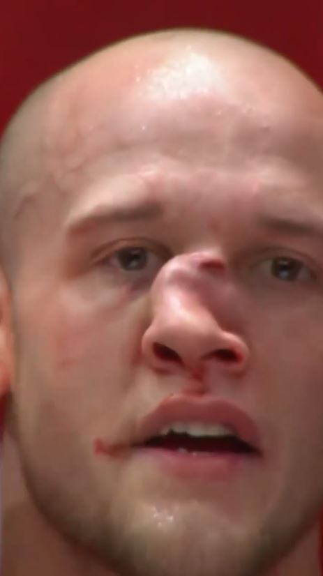 After taking a brutal knee at A1 Combat 4 in Atlanta, MMA star Blake Perry suffered a horrendous bent nose.