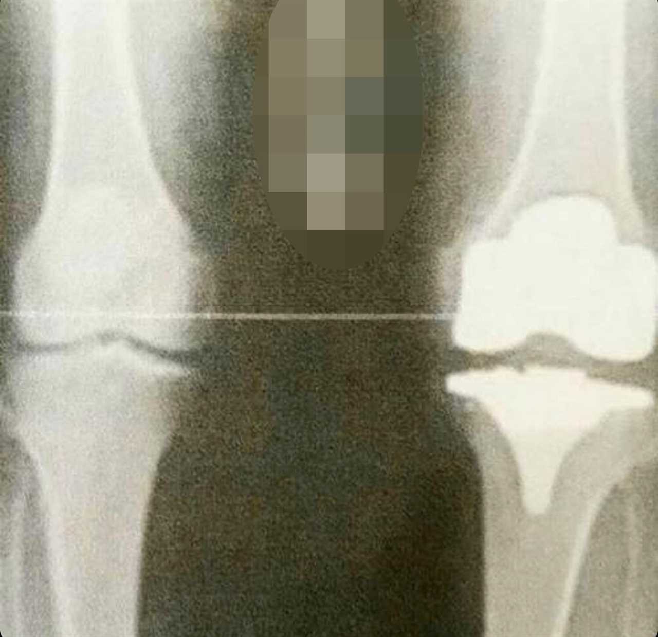 After suffering a terrible knee injury in London, UFC star Tom Aspinall takes a hilarious X-ray