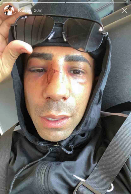 Meet Fousey from YouTube. He was injured in his debut boxing bout and had to have his body dramatically altered after sustaining a broken nose.