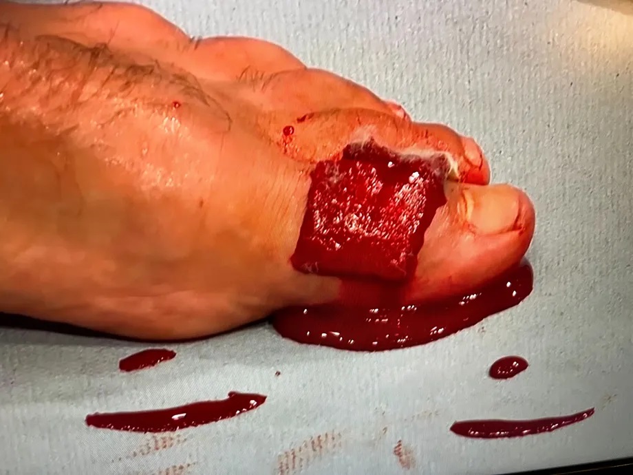 UFC fighter Benoit Saint Denis is severely injured by a toe injury and is left with a swollen ankle.
