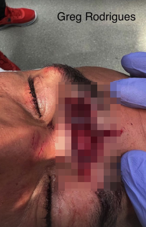 UFC star Greg Rodrigues gets a severe cut to his forehead, but he still wins the fight in Vegas.
