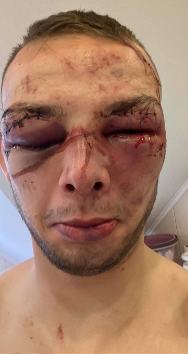 After a bloodbath that left their faces swollen, and with stitches in their eyes, MMA fighters are hard to recognize.