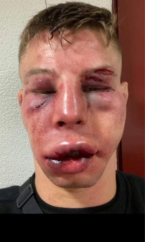After a bloodbath that left their faces swollen, and with stitches in their eyes, MMA fighters are hard to recognize.