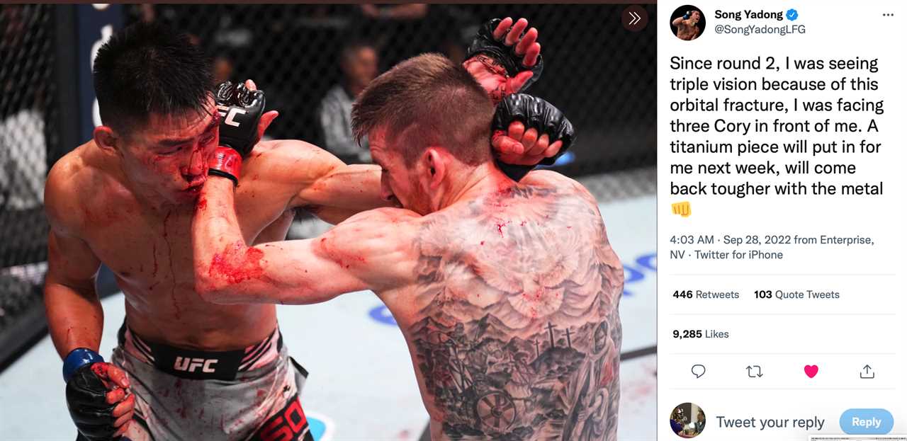 UFC star Song Yadong reveals Xray of fractured orbital which requires titanium plate after seeing a 'triple during bout