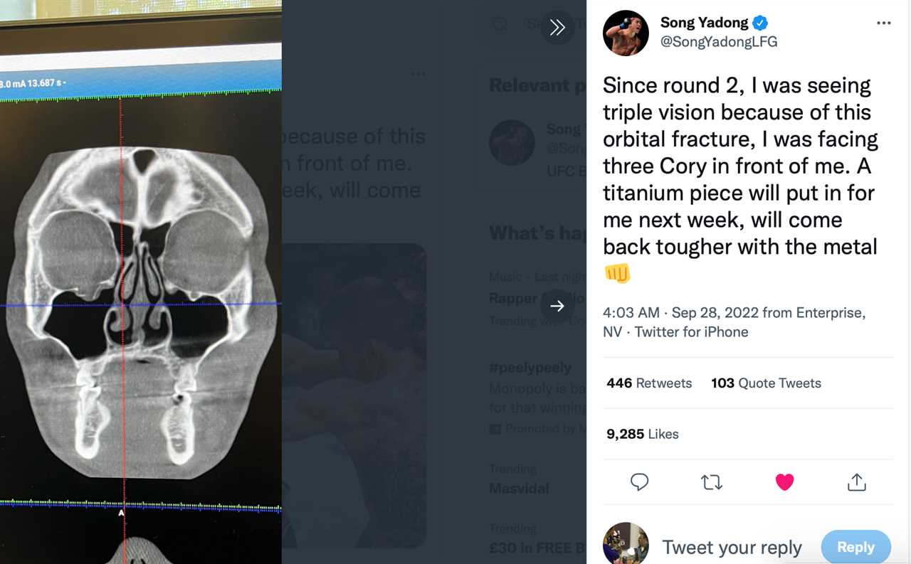 UFC star Song Yadong reveals Xray of fractured orbital which requires titanium plate after seeing a 'triple during bout