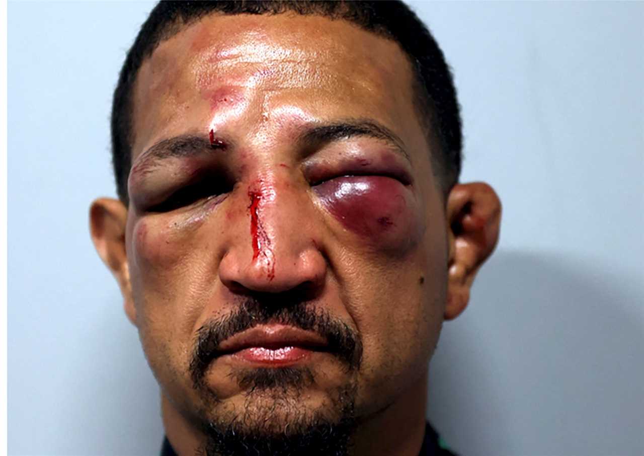 After brutal bloodbath fights, naked-knuckle boxers display horror injuries such as swollen eyes and gruesome cuts