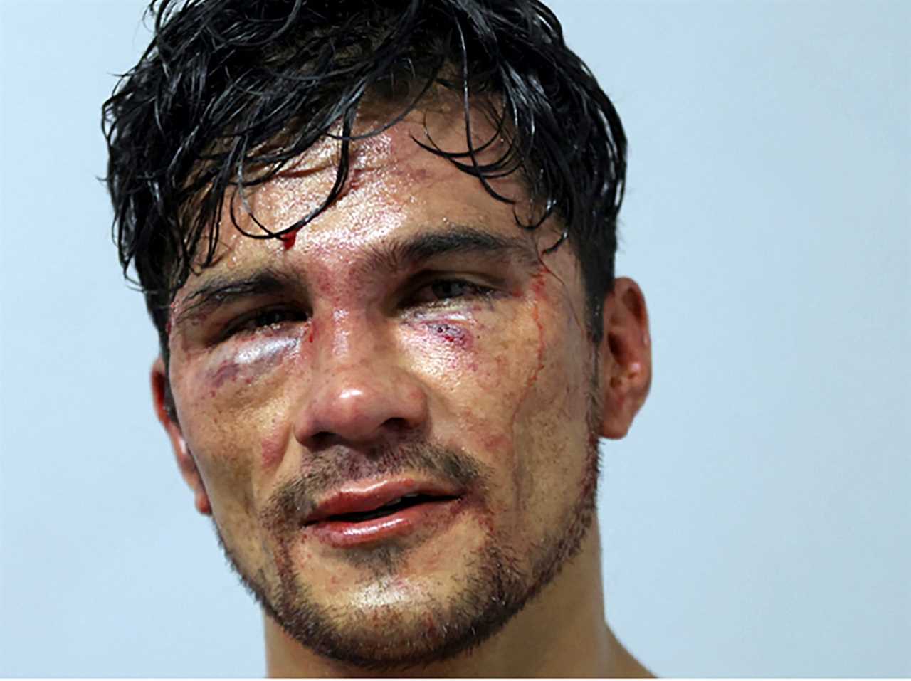 After brutal bloodbath fights, naked-knuckle boxers display horror injuries such as swollen eyes and gruesome cuts