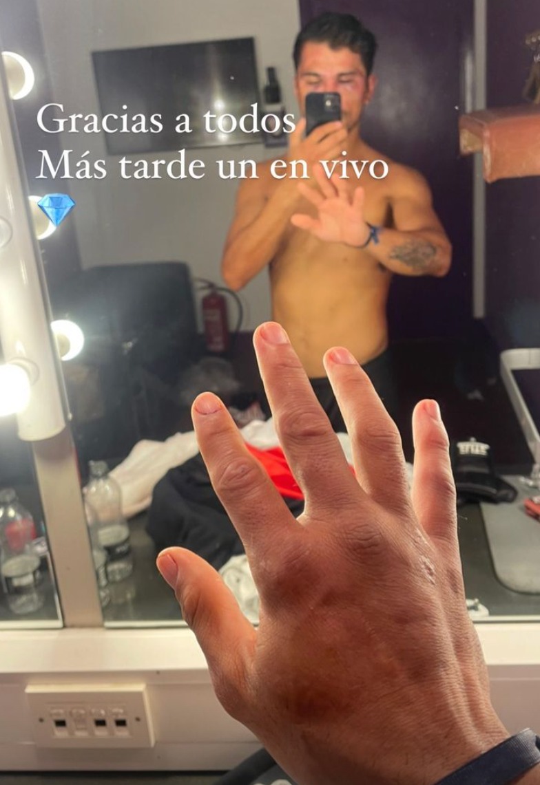 After brutal bloodbath fights, naked-knuckle boxers display horror injuries such as swollen eyes and gruesome cuts