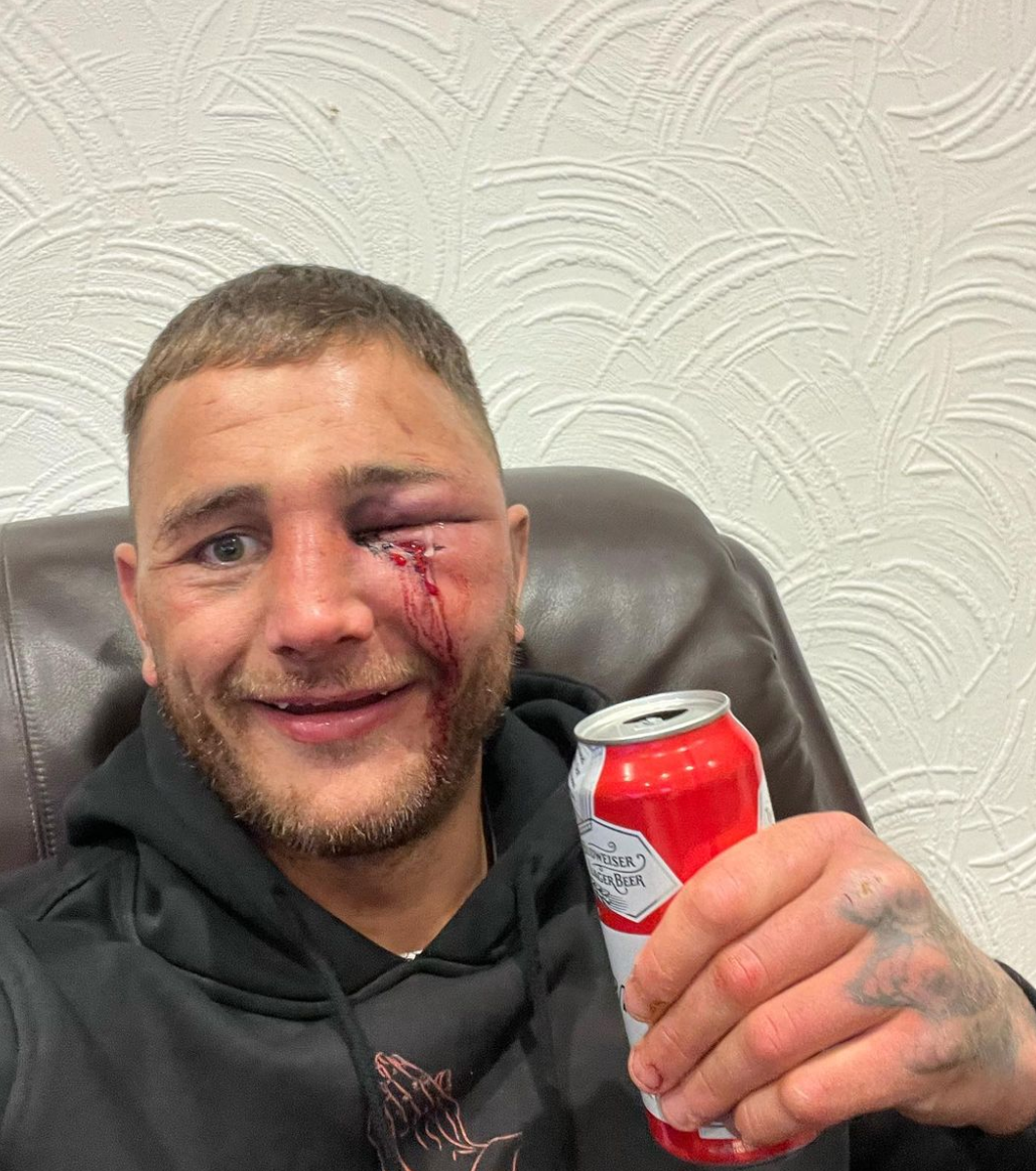 Bare-knuckle boxer Nathan Decastro looks unrecognisable after taking brutal beating as he shows off gruesome eye injury