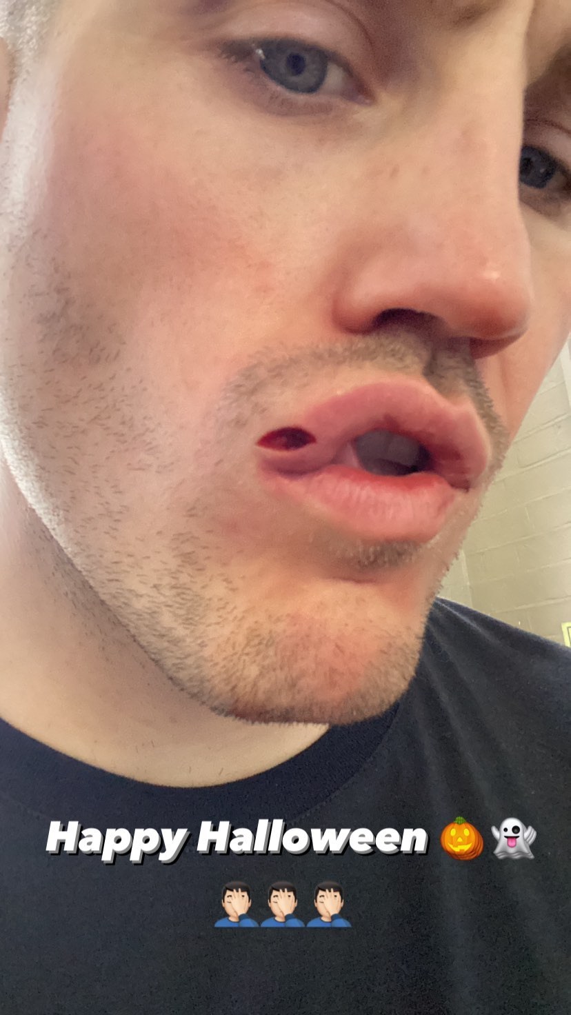 Shane McGuigan displays a horrifying split lip that requires stitches after Daniel Dubois punched him in the face