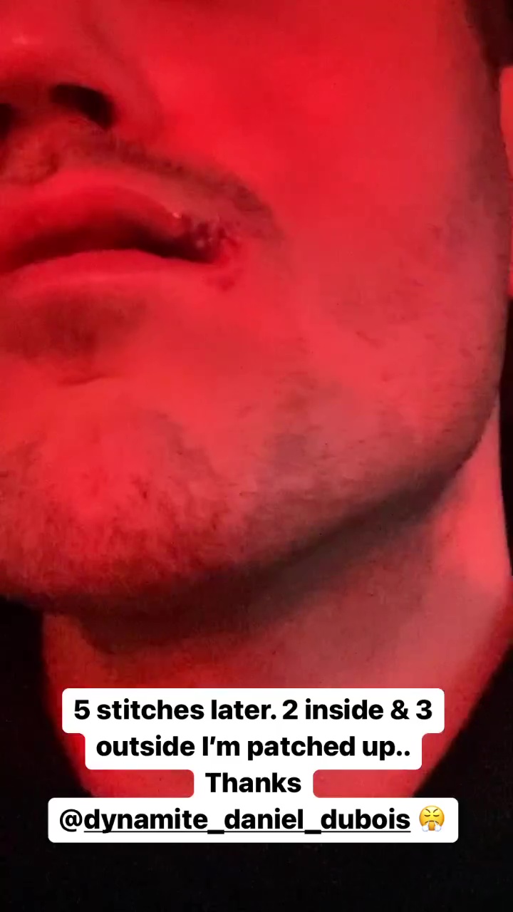Shane McGuigan displays a horrifying split lip that requires stitches after Daniel Dubois punched him in the face