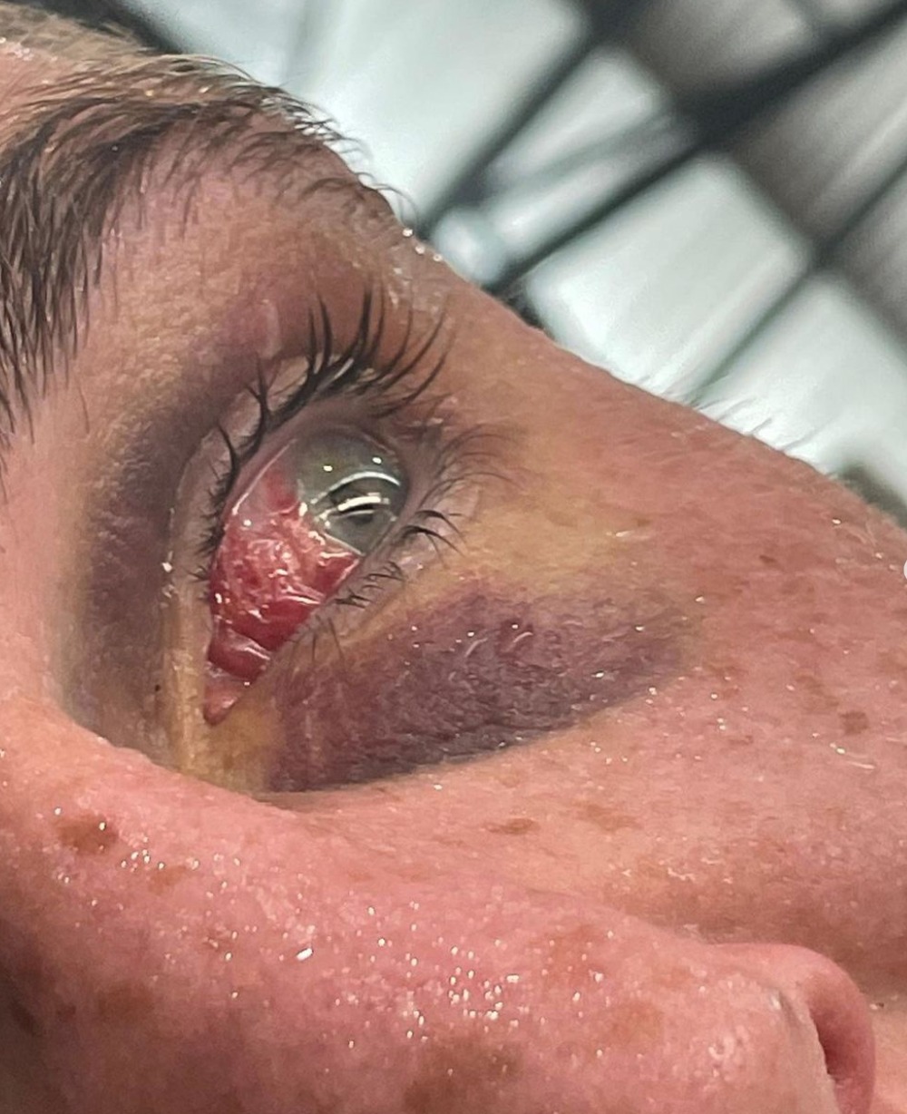 UFC star Darren Till displays a horrific eye injury and hints that he was given shiner during sparring