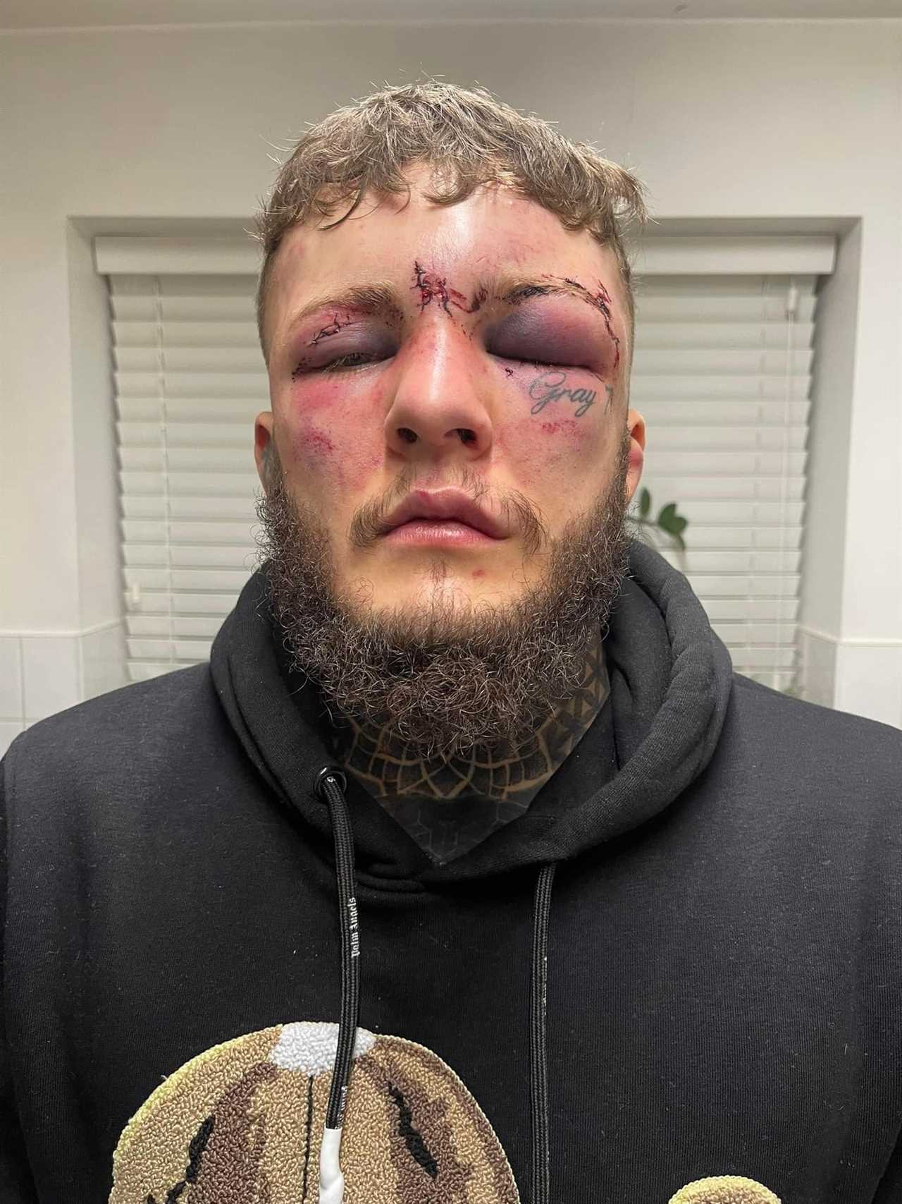 After suffering horrific facial injuries from bloodbath Cage Warriors 145, MMA star Jordan Vecunic isn't the same Jordan Vecunic.
