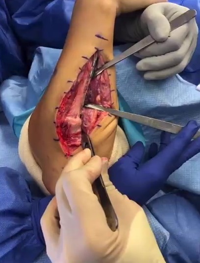 Paige VanZant's horrific broken arm, which required surgery and left her with a severe scarring after UFC fight
