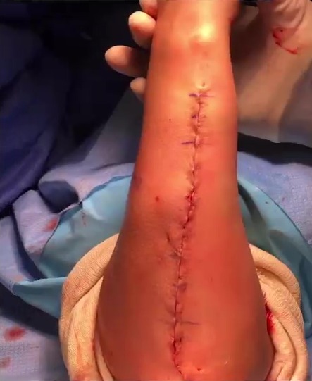 Paige VanZant's horrific broken arm, which required surgery and left her with a severe scarring after UFC fight