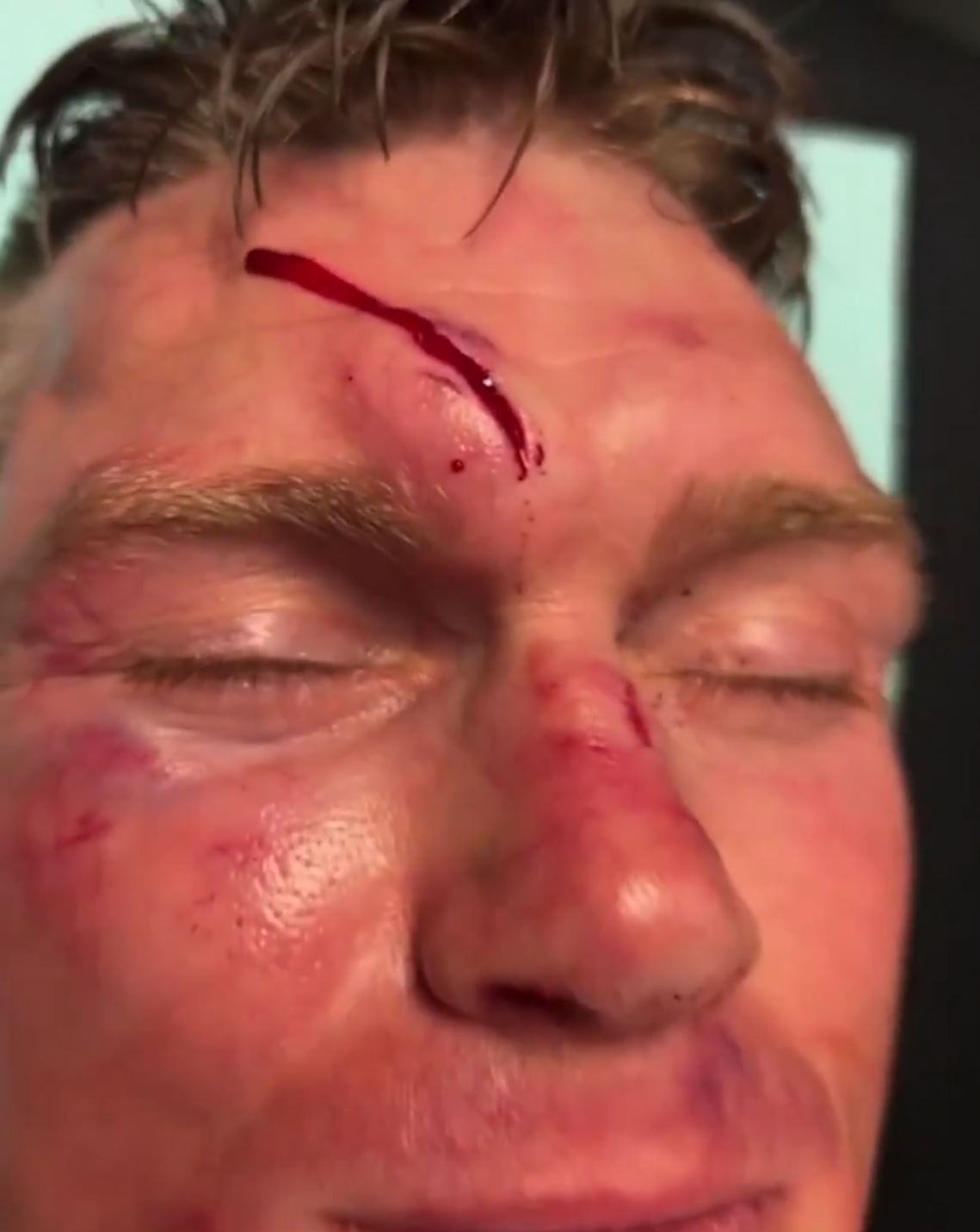 UFC stars Stephen Thompson & Kevin Holland display horrific battle scars, including broken hands and severe cuts