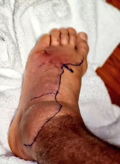 UFC star Dustin Pourier displays a horrendous swelling of his foot in hospital while battling a potentially fatal staph infection
