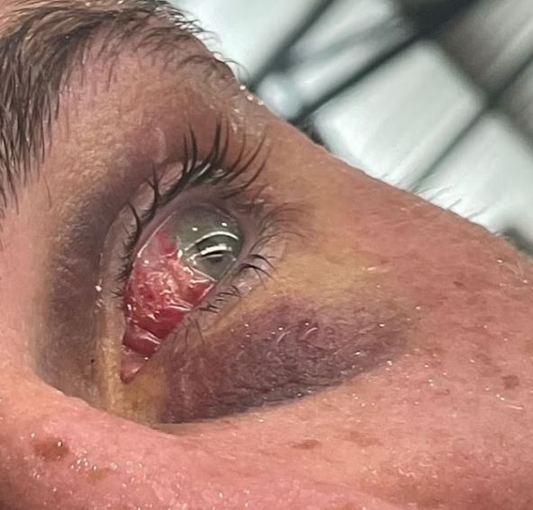 UFC star Darren Till suffered a terrible eye poke injury that caused him to feel his finger and brain go to the back.