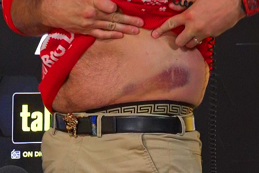 After receiving brutal body shots by Derek Chisora, Tyson Fury displays a nasty bruised waist