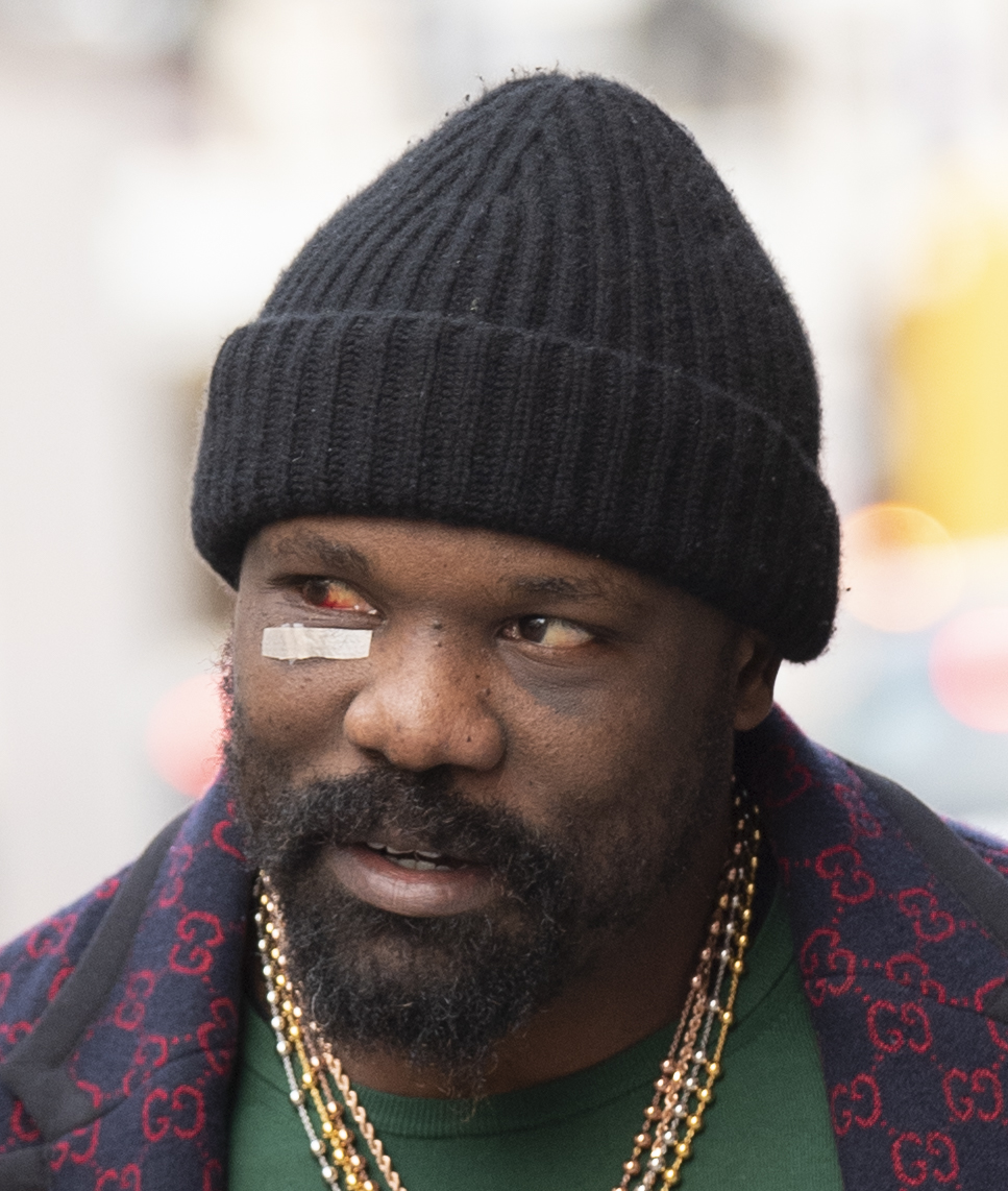 Derek Chisora, a manager shopping for scented candles, shows off his horrendous-looking eye injury from Tyson Fury defeat.